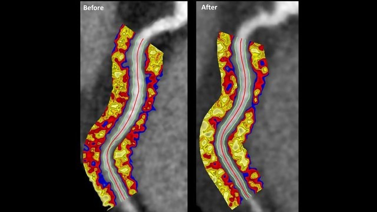 Psoriasis Therapy Linked to Reduced Coronary Inflammation