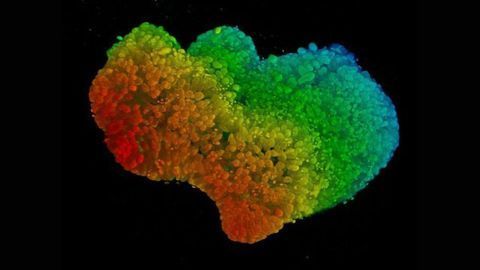 Endometrial Organoids Developed From Diseased Tissue