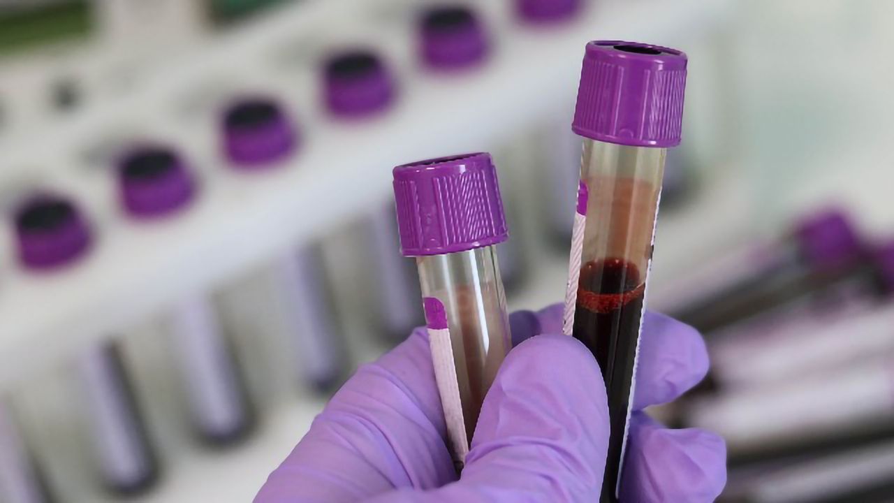 Personalised Liquid Biopsy Could Detect Return of Breast Cancer Nearly Eleven Months Earlier than Hospital Scans