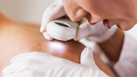 Skin Cancer: What Causes It and Who Is at Risk?