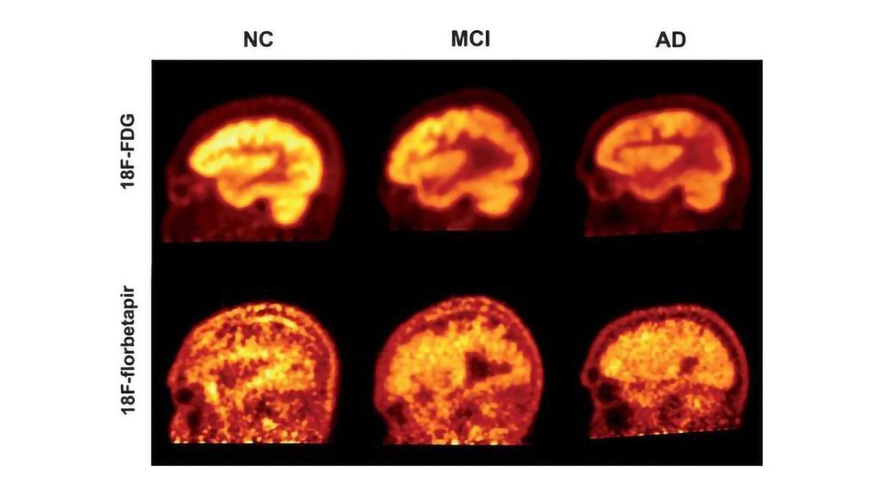 Amyloid PET Scans Say Little About Cognitive Function