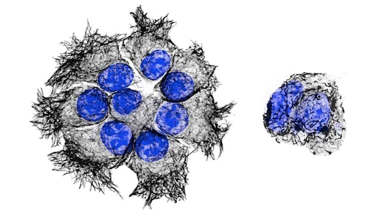 Pancreatic Cancer: Less Toxic Drug May Improve Therapy
