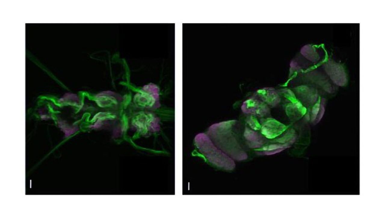 Seizures Associated With Cardiac Disease: What Role Does Genetics Play?