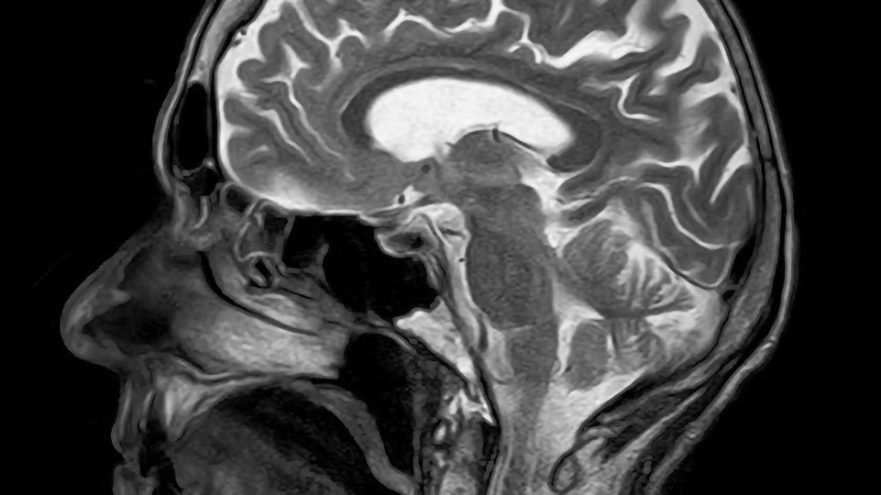 Adding MS Drug to Targeted Cancer Therapy may Improve Glioblastoma Outcomes