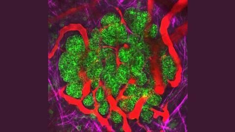 Team Reveals How Pancreatic Cancer Cells Spread