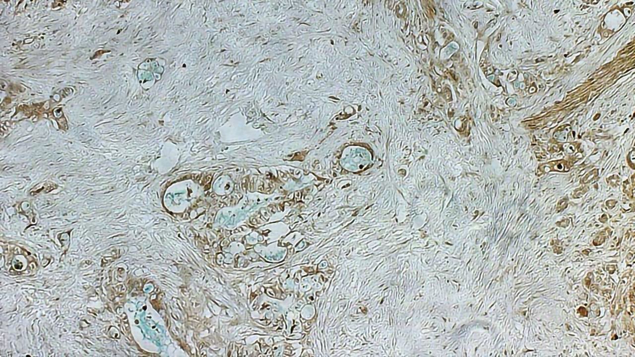 Rare, Inherited Gene Mutation Raises the Risk of Pancreatic Cancer