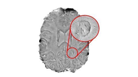 "Smoldering" Spots in the Brain May Indicate MS Severity