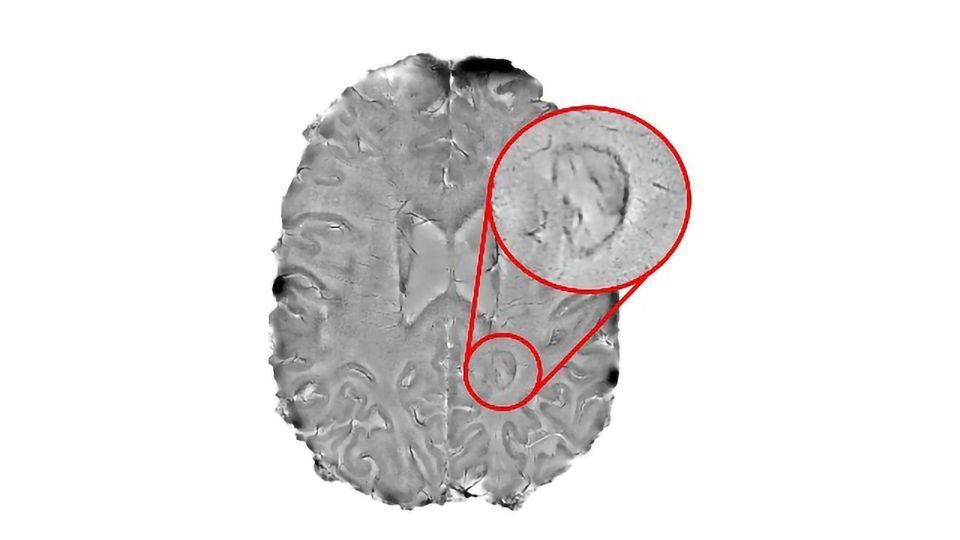 "Smoldering" Spots in the Brain May Indicate MS Severity content piece image