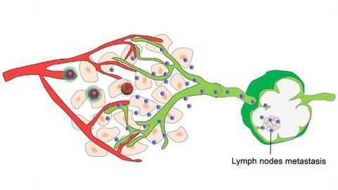 Nanoparticle Drugs Pass Through Lymphatics to Destroy Metastases