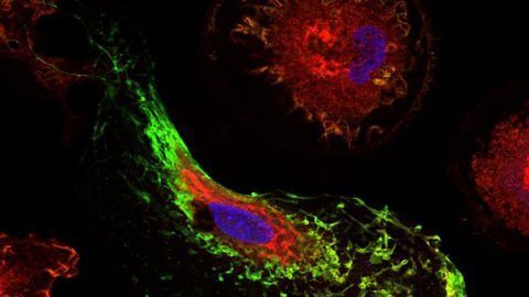 Pair of Genes ID’d That Influence Risk for Alzheimer’s Disease
