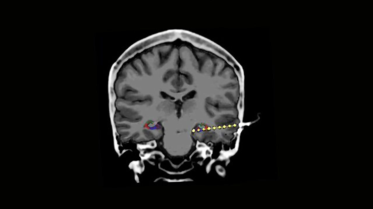 Watching the Brain's "Firework Memories"