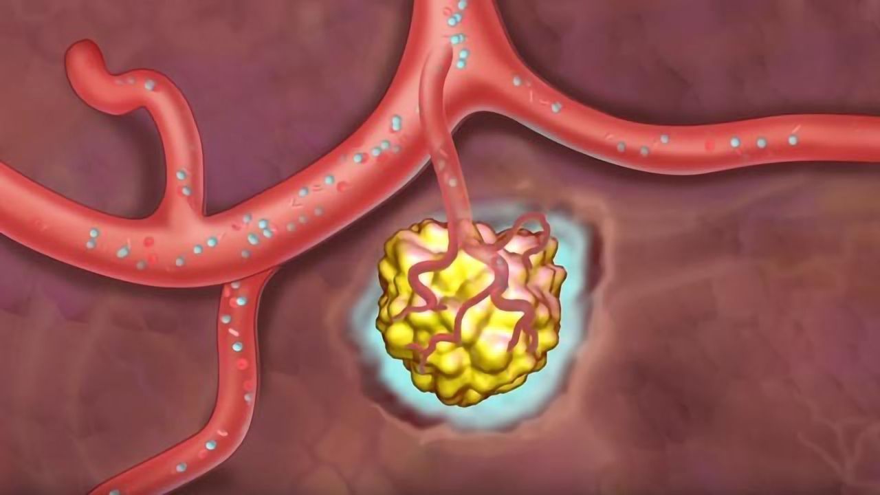 Metastasis: How Cancer Spreads