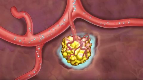 Metastasis: How Cancer Spreads