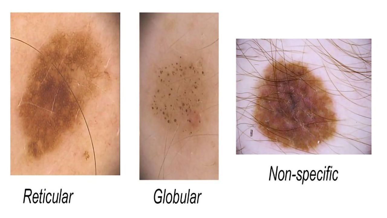 In Melanoma, Numbers Count
