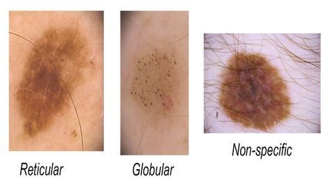 In Melanoma, Numbers Count