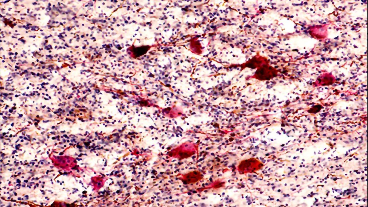 Alzheimer's Disease Destroys the Neurons That Keep Us Awake