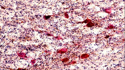 Alzheimer's Disease Destroys the Neurons That Keep Us Awake