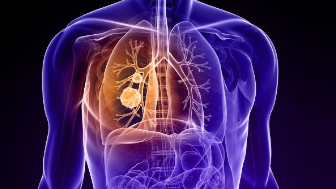 Drug Screens Identify Potential Lung Cancer Treatment