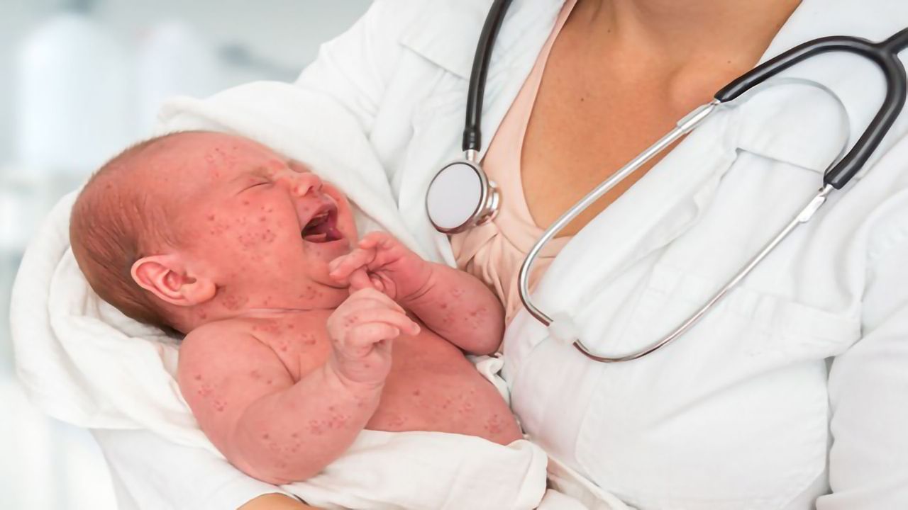 Pressure to Fight Vaccine Hesitancy As Measles Cases Soar