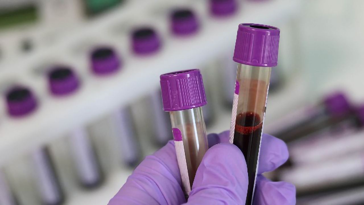 Aggressive Brain Tumour Could Be Diagnosed With Simple Blood Test