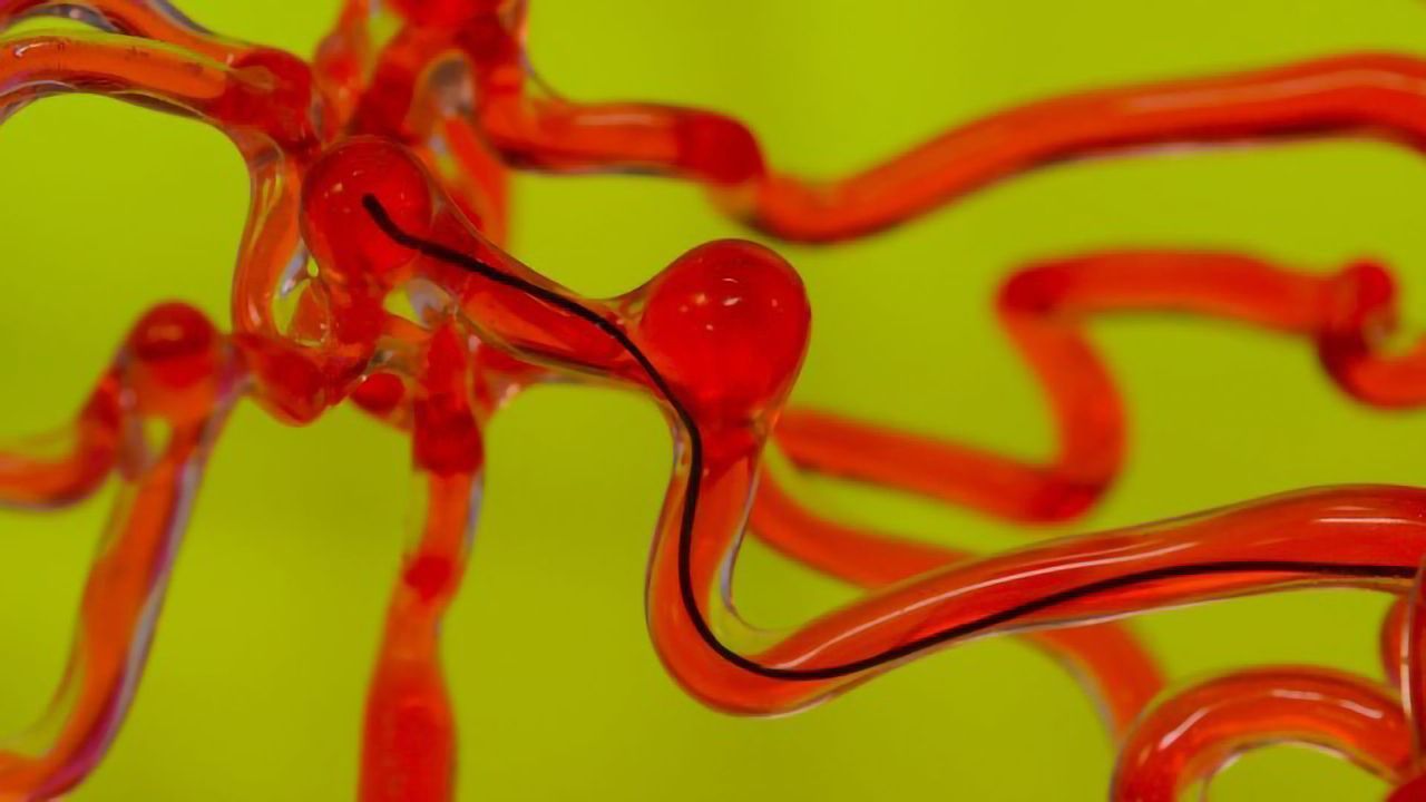 This Surgical Noodle Could Repair the Brain by Slipping Into Blood Vessels