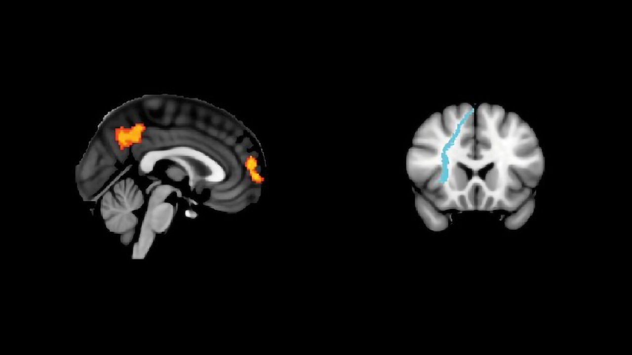 White Matter Connections Could Be the Key to Successful Brain Stimulation