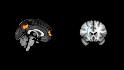 White Matter Connections Could Be the Key to Successful Brain Stimulation