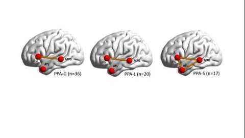 Dysfunctional Brain Networks Behind Speech-stealing Dementia Revealed