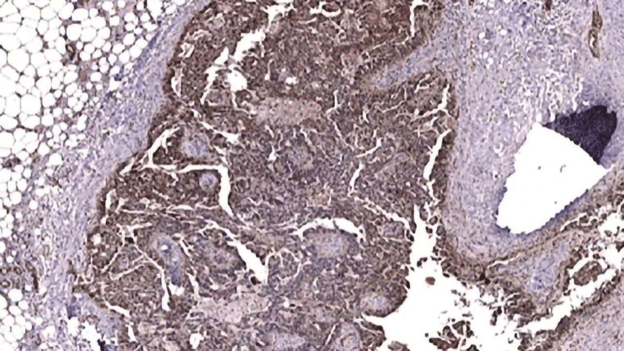 FAK Protein Linked to Chemo Resistance in Ovarian Cancer