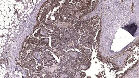FAK Protein Linked to Chemo Resistance in Ovarian Cancer