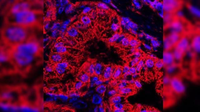 Protein Causes Most Common Type of Pancreatic Cancer content piece image 