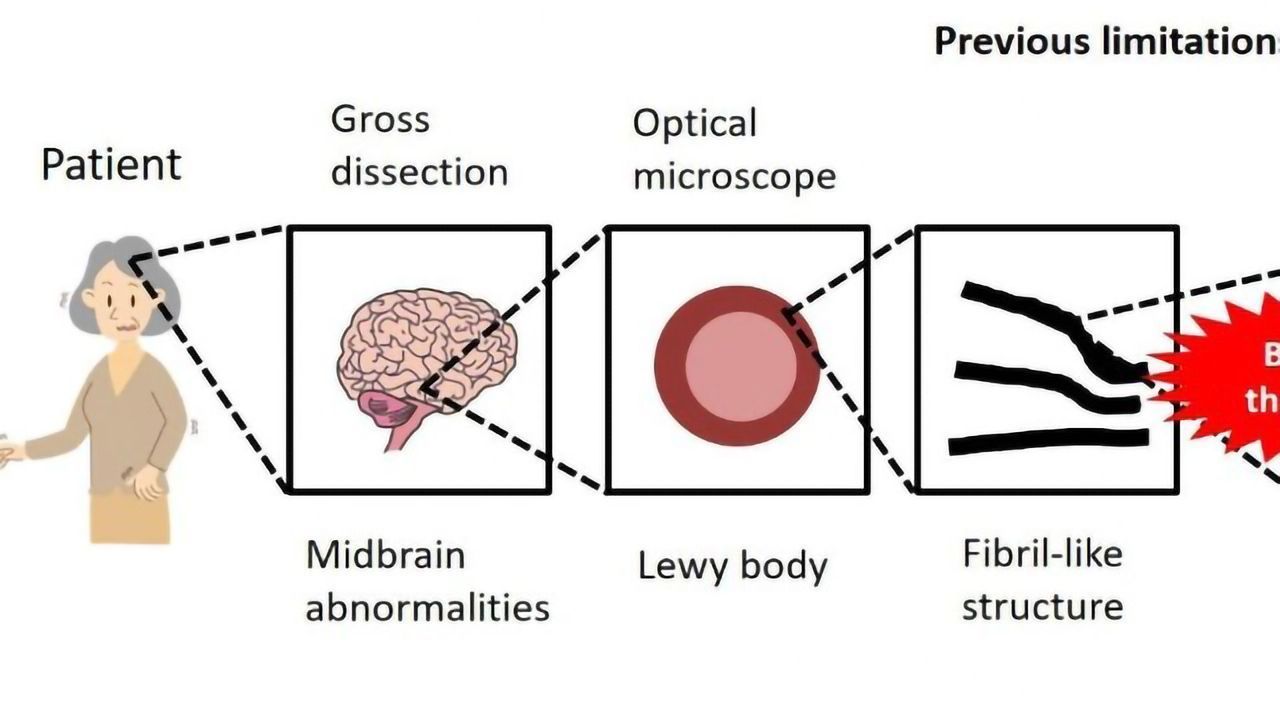 Parkinson’s Disease: Amyloid Fibrils Can Move Through the Brain, New Findings Illustrates