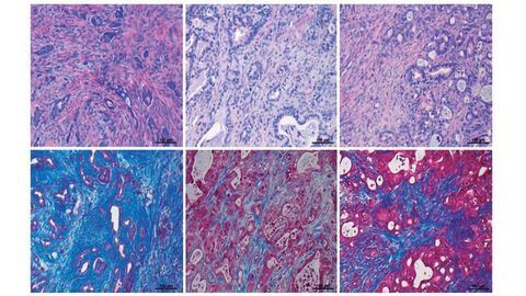 Tackling Resistance in Pancreatic Cancer