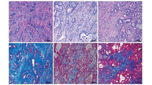 Tackling Resistance in Pancreatic Cancer content piece image 