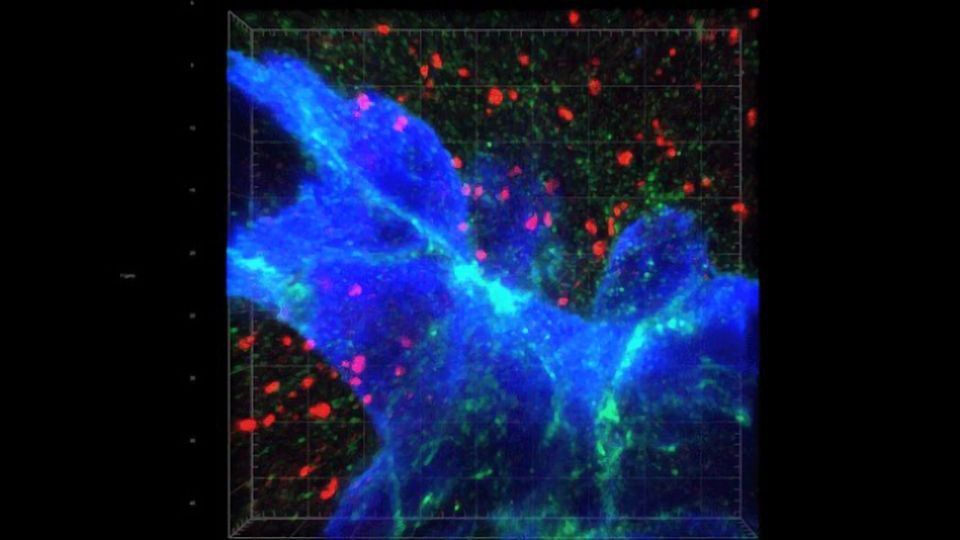 Cancer Metastasis – Moving From Breast to Brain content piece image