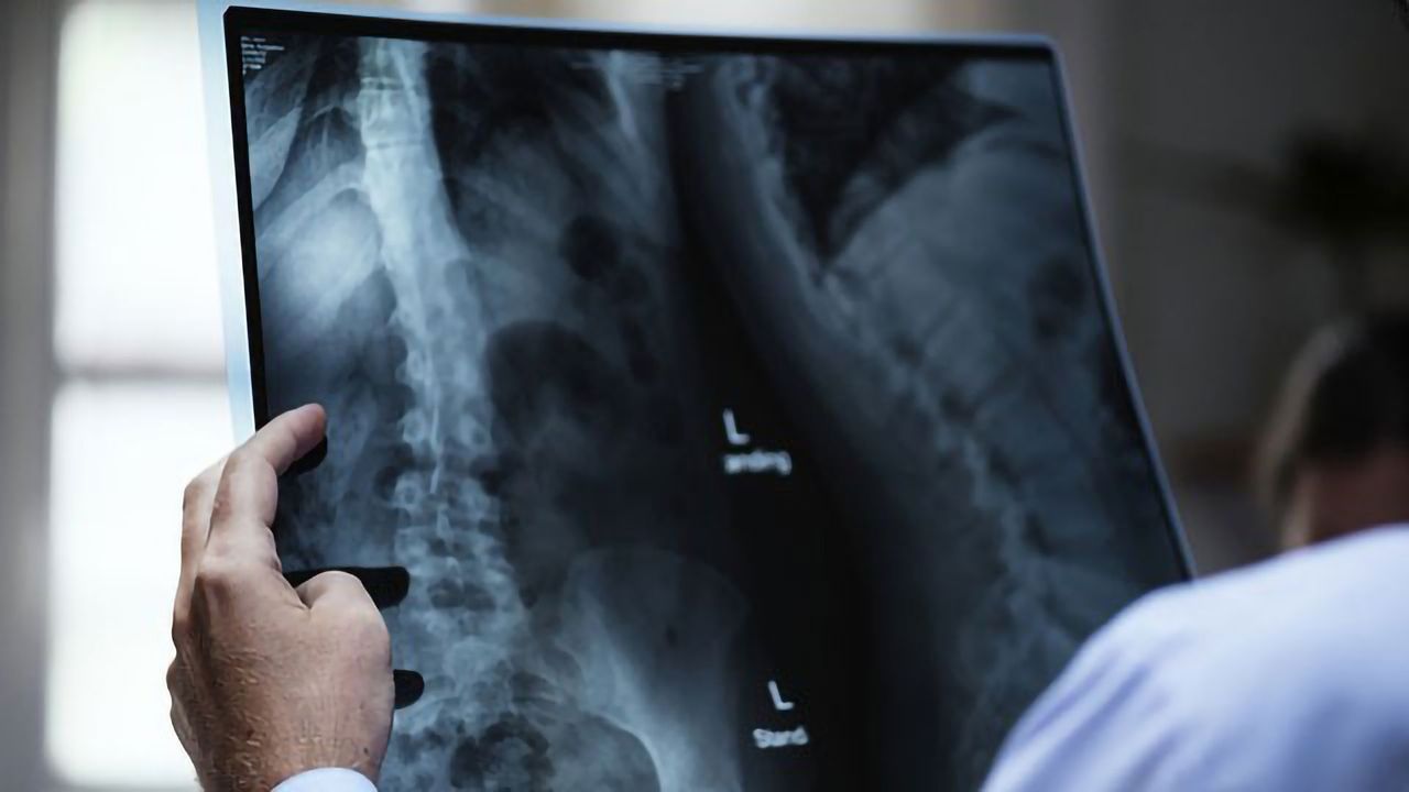 Psoriasis Drug Target Holds Potential for Bone Cancer