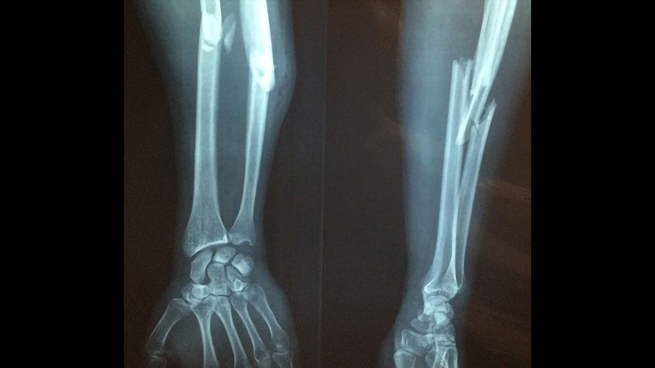Team Discover Protein That Hampers Bone Healing
