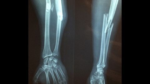 Team Discover Protein That Hampers Bone Healing