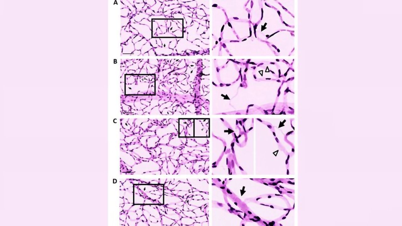 A Potential Drug Target for Diabetic Retinopathy