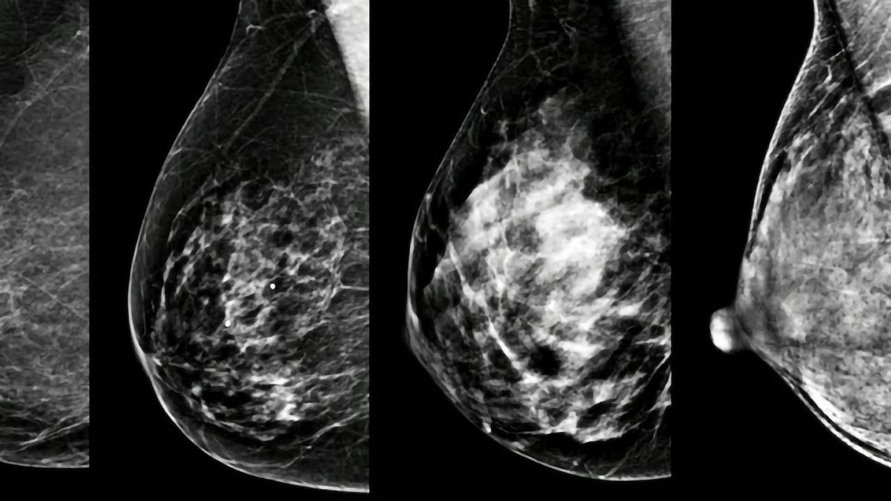 Breast Density: A Personal Biomarker of Cancer