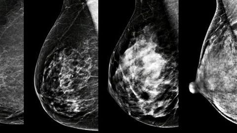 Breast Density: A Personal Biomarker of Cancer