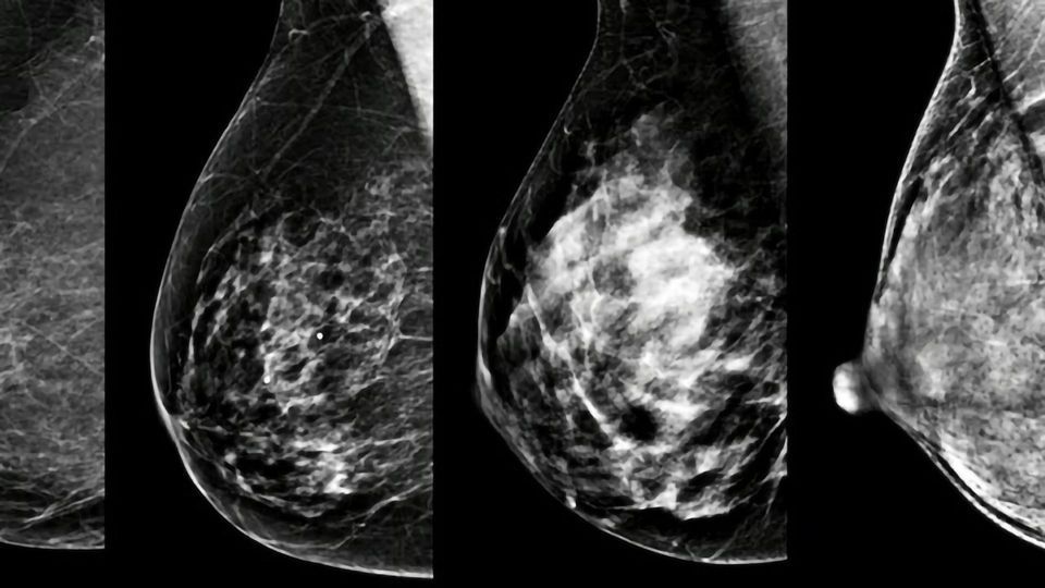 Breast Density: A Personal Biomarker of Cancer content piece image