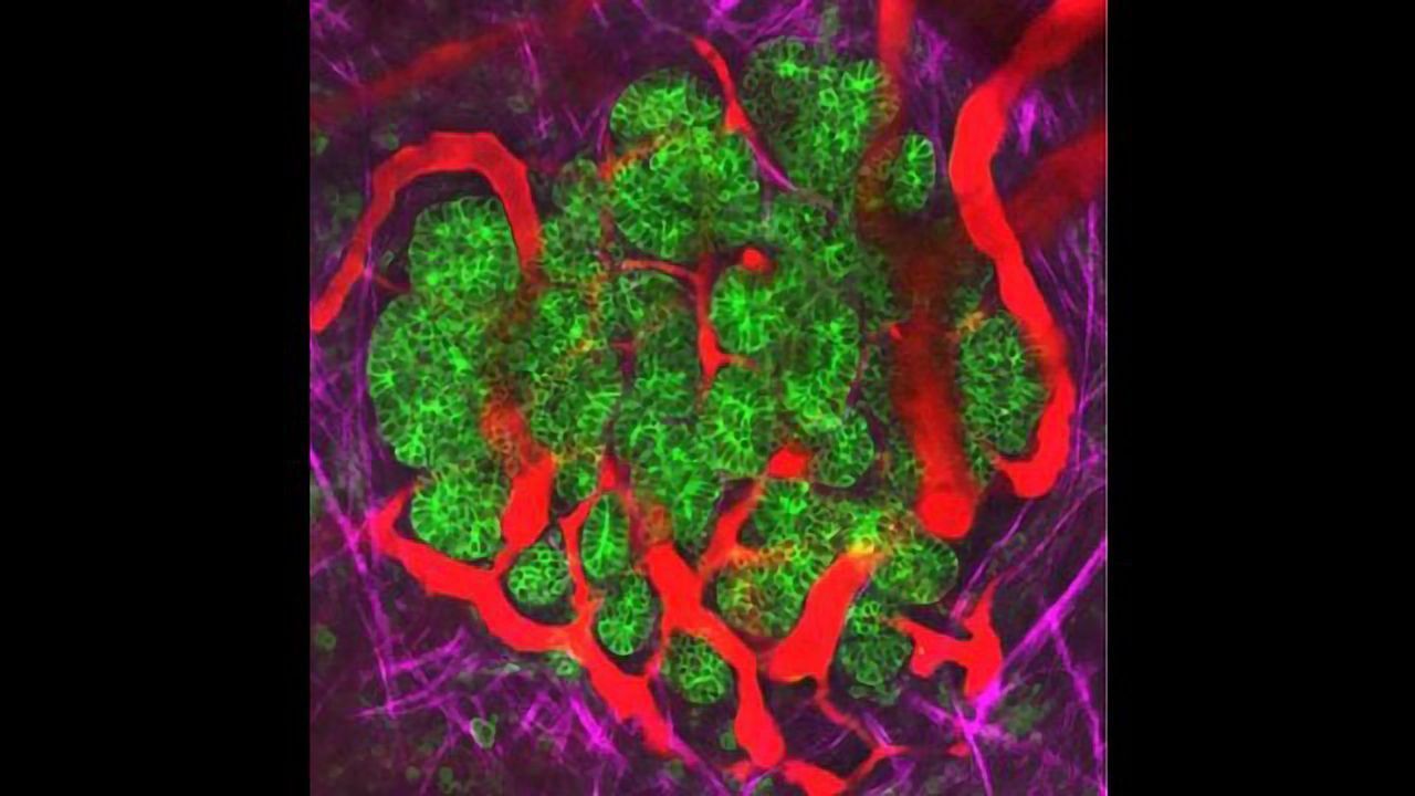 Cancer Cells Interwoven With Blood Vessels and Matrix Fibers