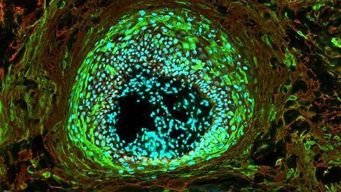 Using Keratin To Assess and Diagnose Skin Cancer
