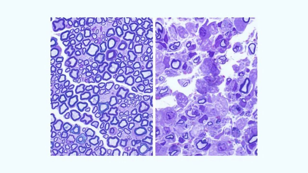 Cause of Fatal Childhood Disorder Krabbe Disease Identified