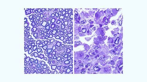 Cause of Fatal Childhood Disorder Krabbe Disease Identified
