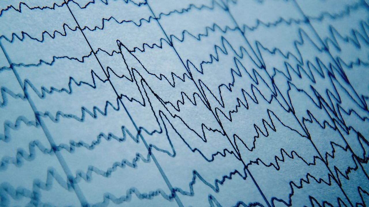 Brain Waves Prove Ineffective for Predicting Epileptic Seizures