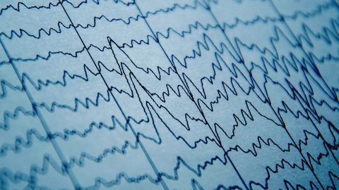 Brain Waves Prove Ineffective for Predicting Epileptic Seizures