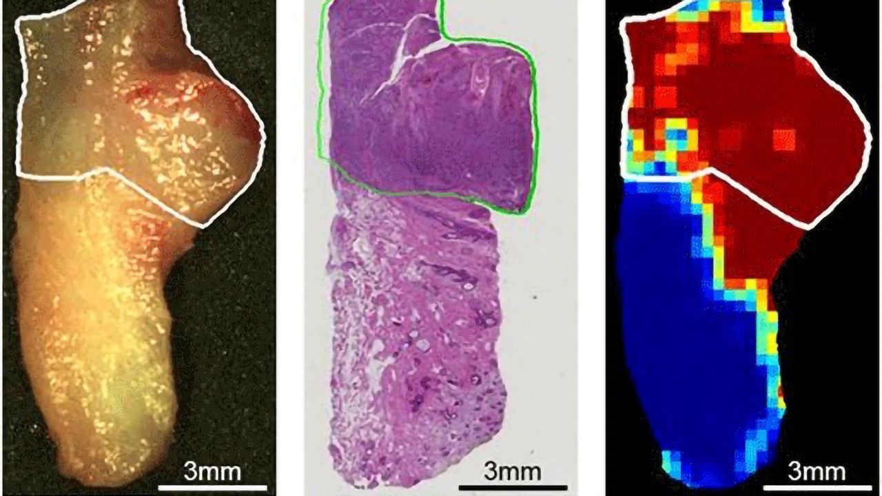 Illuminating Cancer During Surgery