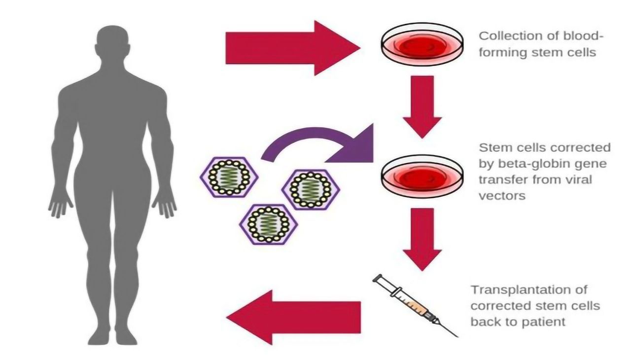 Improved Gene Therapy in Sickle Cell Disease